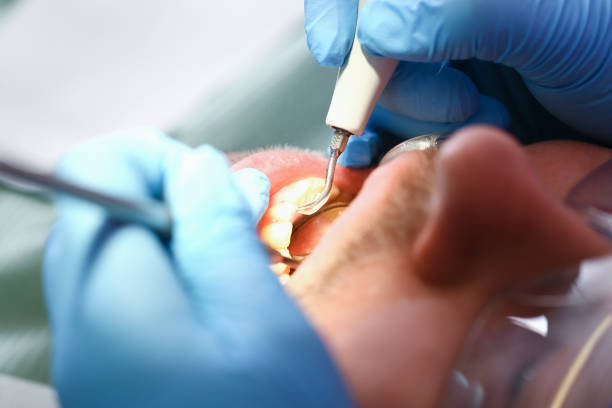Best Emergency Wisdom Teeth Removal in El Verano, CA