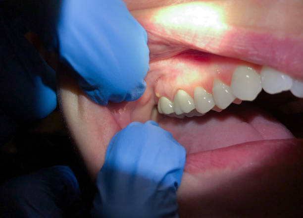 Best Emergency Wisdom Teeth Removal in El Verano, CA